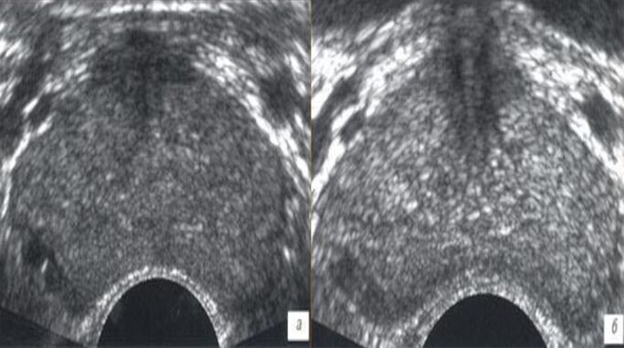 Ultraschall vor und nach der Behandlung mit Prostovit-Tropfen