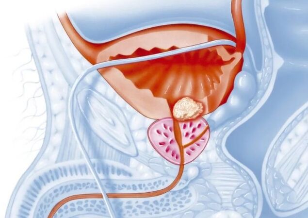 Merkmale der chronischen Form der Prostatitis