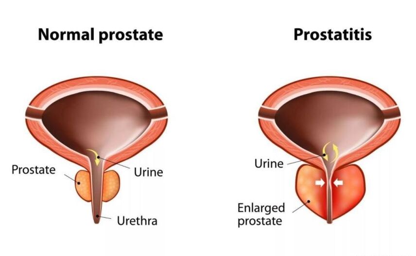 Normale Prostata und entzündet